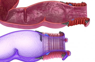 Hemorrhoids